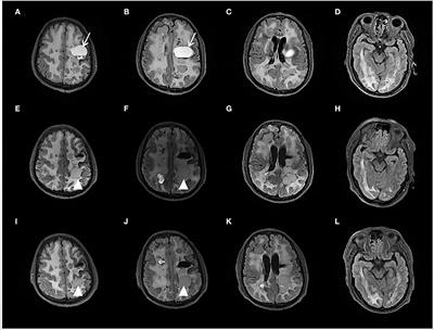 Case report: Moderate therapeutic response to Bevacizumab in late-onset Labrune syndrome